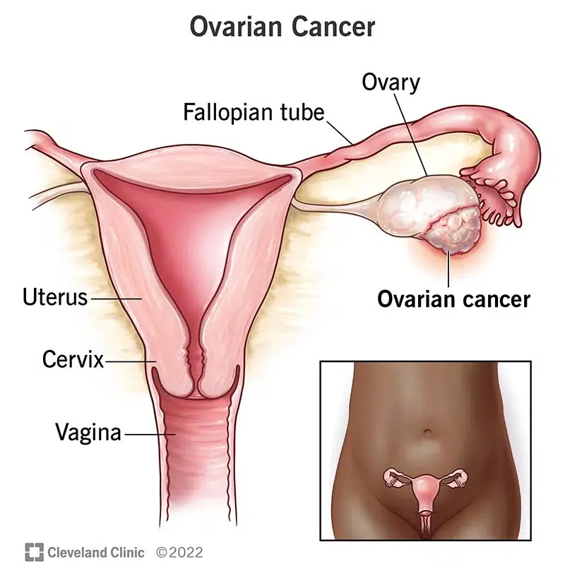 Photo of Ovarian Cancer